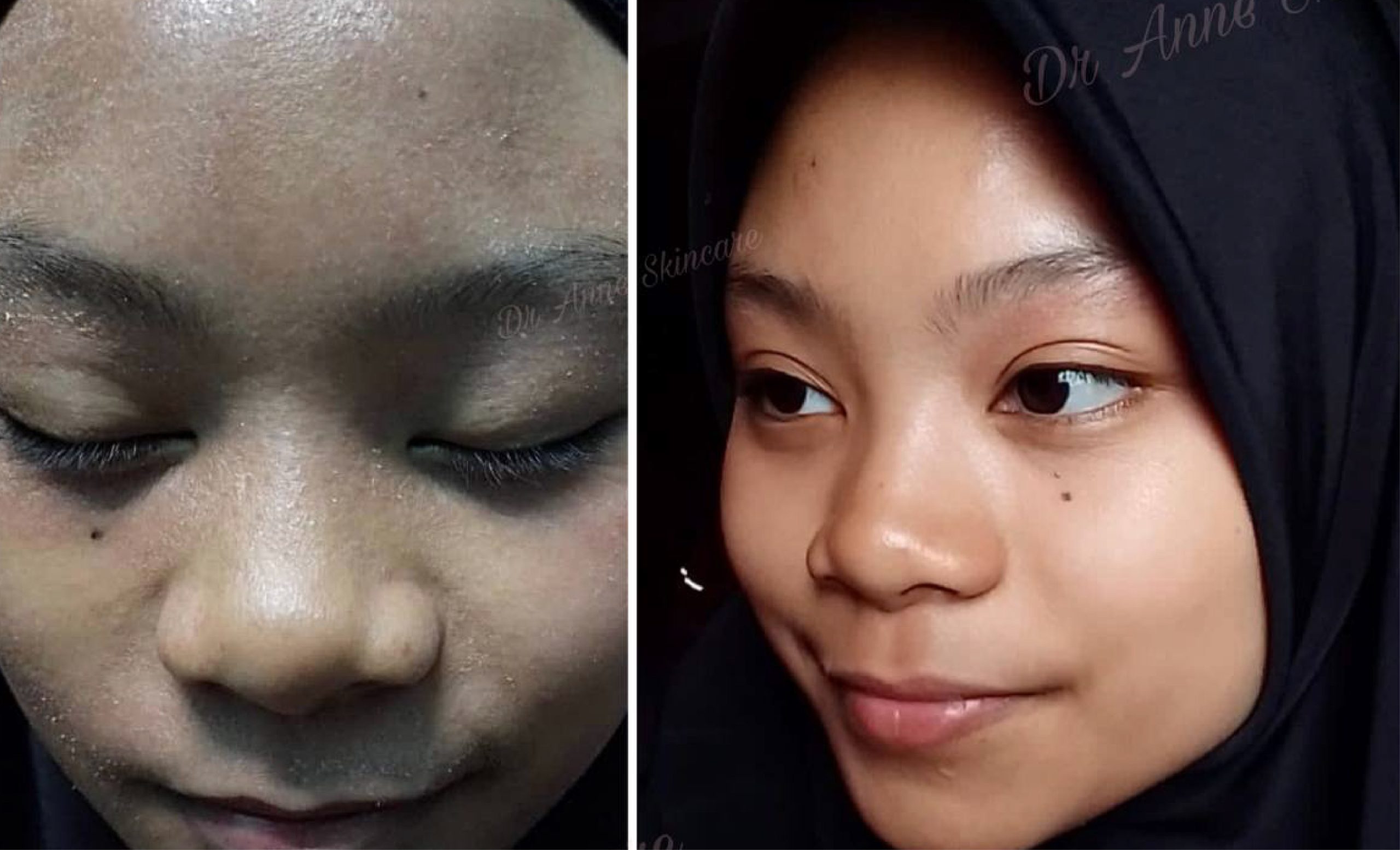 Keputusan sebelum dan selepas menggunakan Dr Anne