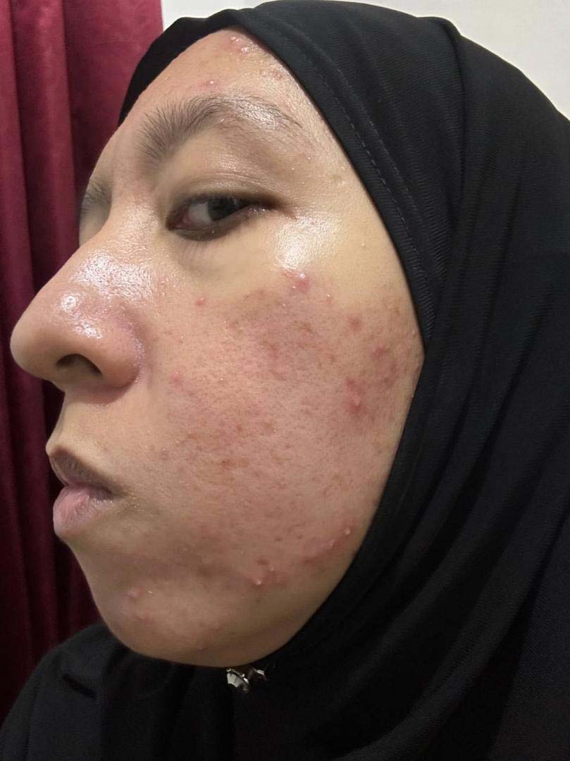 Masalah jerawat berulang pada kulit
