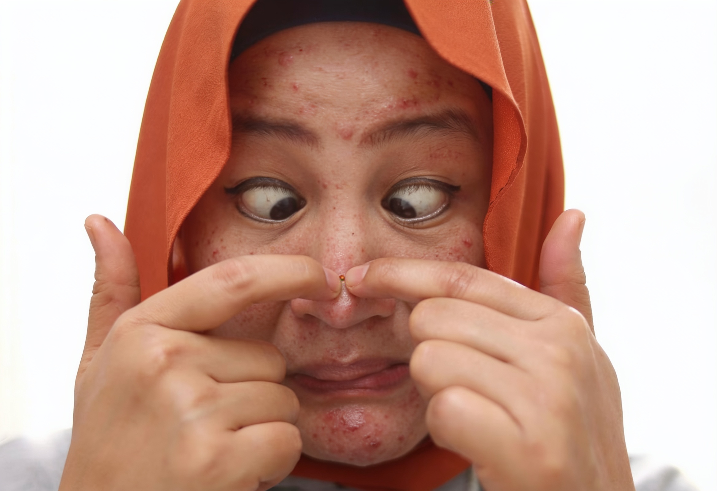 Kesan jerawat pada wajah