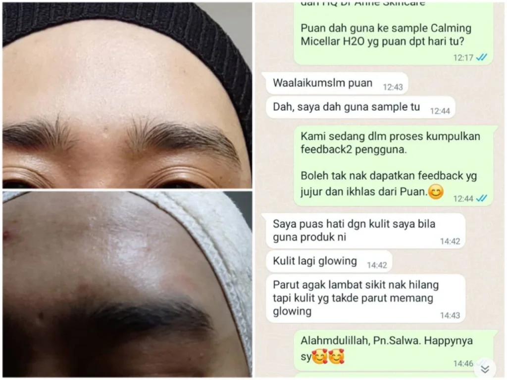 Testimoni Jerawat Dr Anne