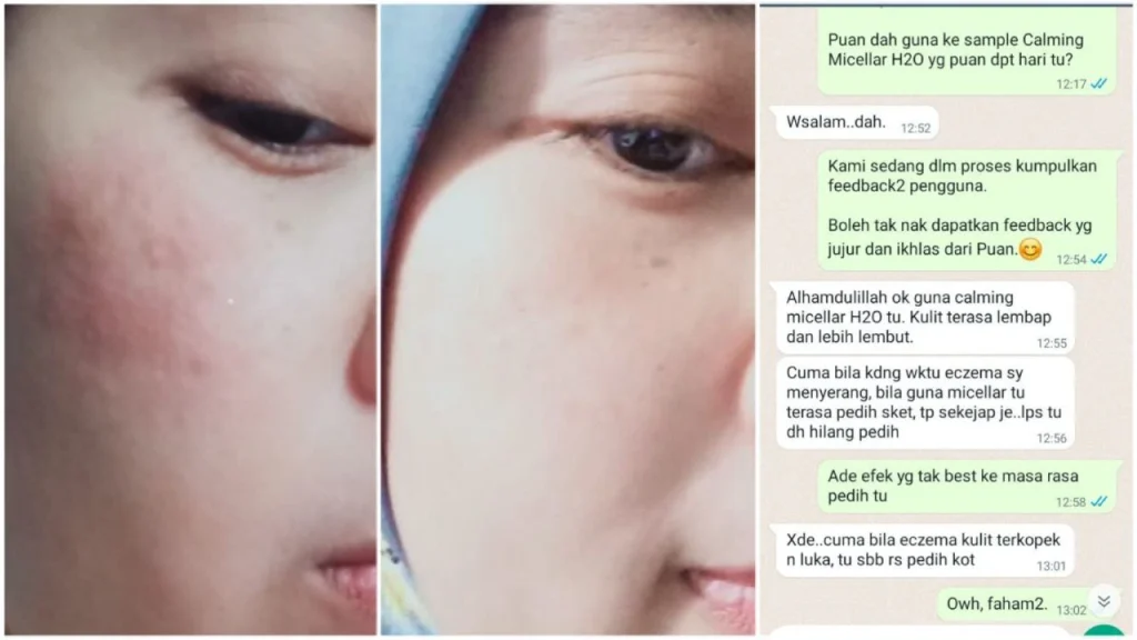 Testimoni Jerawat Dr Anne